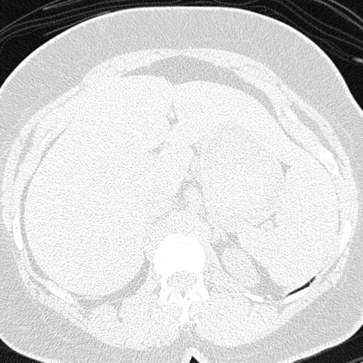 File:Air trapping in small airway disease (Radiopaedia 61685-69694 Axial lung window 203).jpg