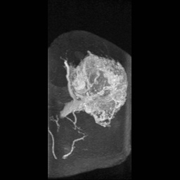 Alveolar soft part sarcoma (Radiopaedia 64501-73678 D 14).jpg