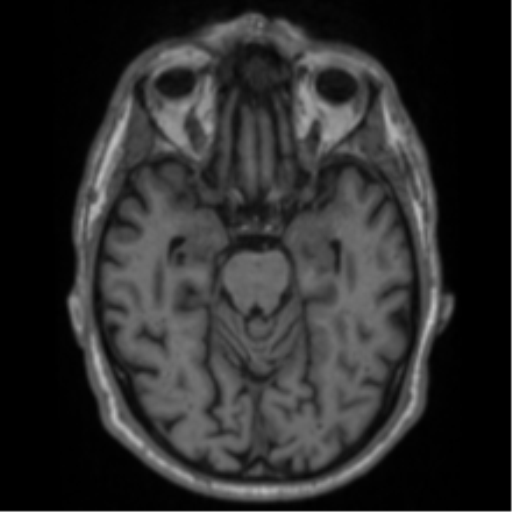 File:Alzheimer's disease- with Gerstmann syndrome and dressing apraxia (Radiopaedia 54882-61150 Axial T1 27).png