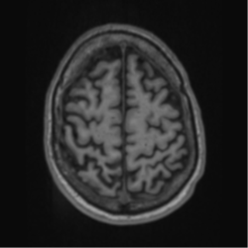 Alzheimer's disease- with apraxia (Radiopaedia 54763-61011 Axial T1 60).png