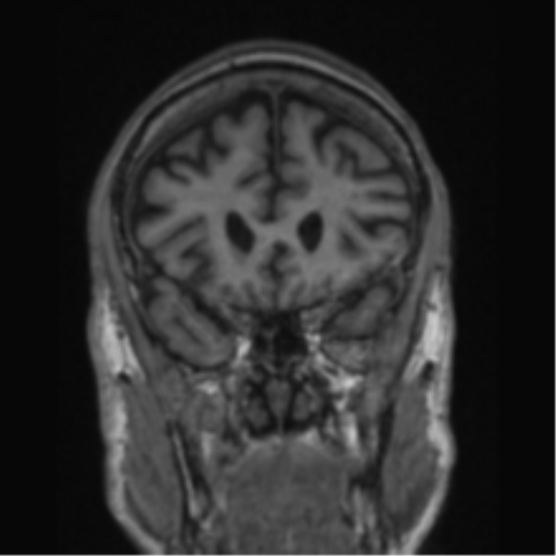 File:Alzheimer's disease- with apraxia (Radiopaedia 54763-61011 Coronal T1 67).png