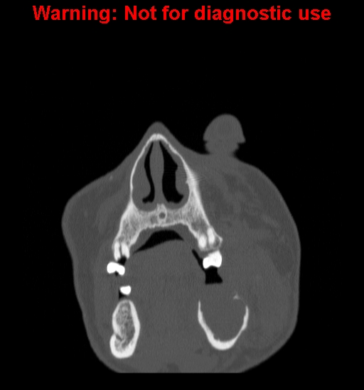 File:Ameloblastoma (Radiopaedia 13276-13280 Coronal non-contrast 3).jpg