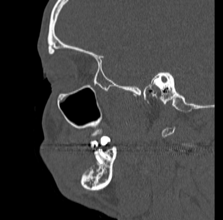 Ameloblastoma (Radiopaedia 77750-89997 Sagittal bone window 60).jpg
