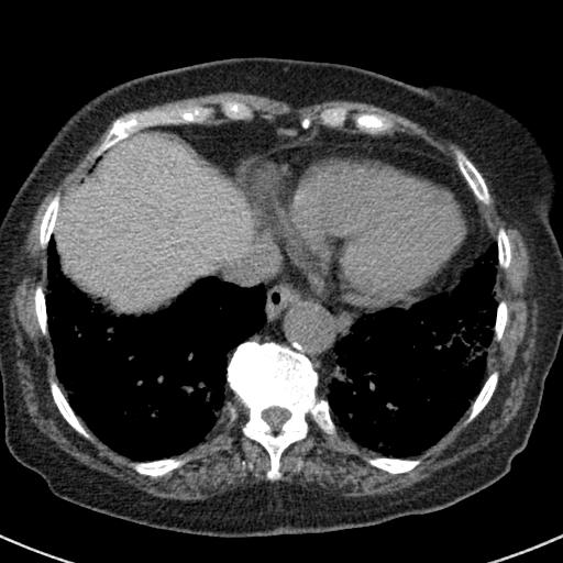 File:Amiodarone-induced pulmonary fibrosis (Radiopaedia 82355-96460 Axial non-contrast 47).jpg