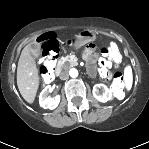 Ampullary adenocarcinoma (Radiopaedia 34013-35237 B 36).png