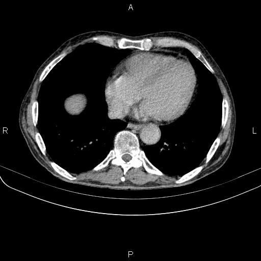 Ampullary adenocarcinoma (Radiopaedia 86093-102033 Axial C+ delayed 3).jpg