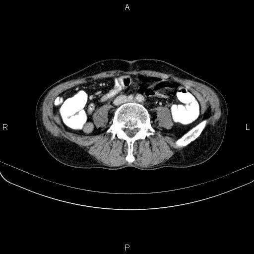 Ampullary adenocarcinoma (Radiopaedia 86093-102033 B 82).jpg