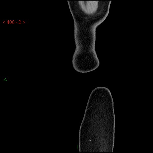 Ampullary carcinoma (Radiopaedia 56396-63056 D 1).jpg