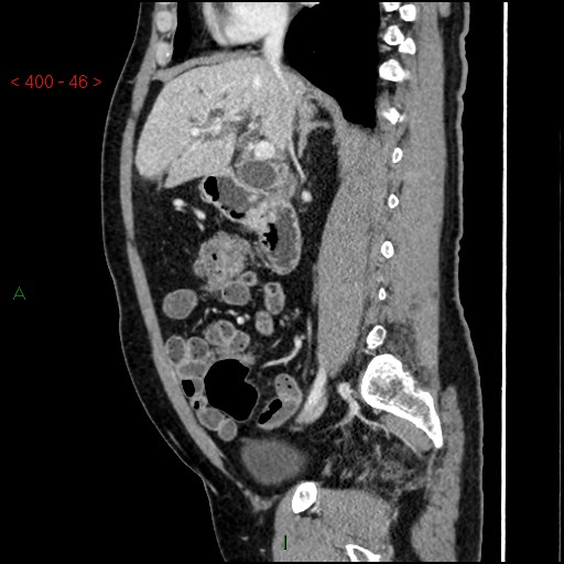 Ampullary carcinoma (Radiopaedia 56396-63056 D 45).jpg