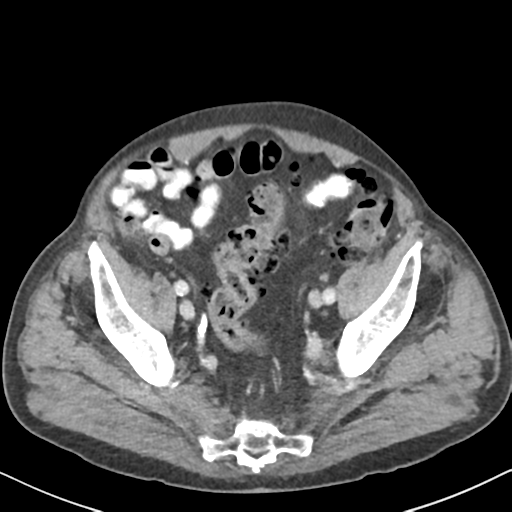 File:Amyand hernia (Radiopaedia 39300-41547 A 58).png
