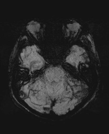 File:Amyloid angiopathy with inflammation (Radiopaedia 30360-31002 Axial SWI MIP 11).jpg