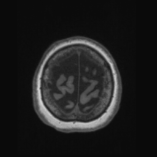 Anaplastic astrocytoma IDH wild-type (pseudoprogression) (Radiopaedia 42209-45276 Axial T1 134).png