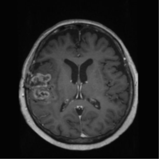 File:Anaplastic astrocytoma IDH wild-type (pseudoprogression) (Radiopaedia 42209-45278 Axial T1 C+ 89).png
