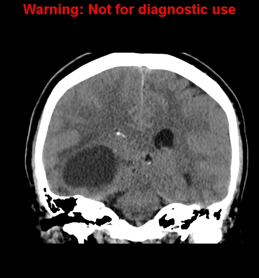 File:Anaplastic ganglioglioma (Radiopaedia 44921-48815 Coronal non-contrast 23).jpg