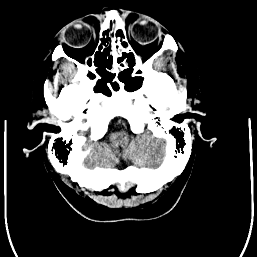 File:Anaplastic meningioma with recurrence (Radiopaedia 34452-35781 Axial non-contrast 5).png