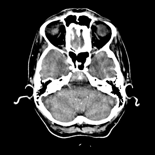 File:Aneursym related subarachnoid hemorrhage with hydrocephalus (Radiopaedia 45105-49084 D 12).jpg