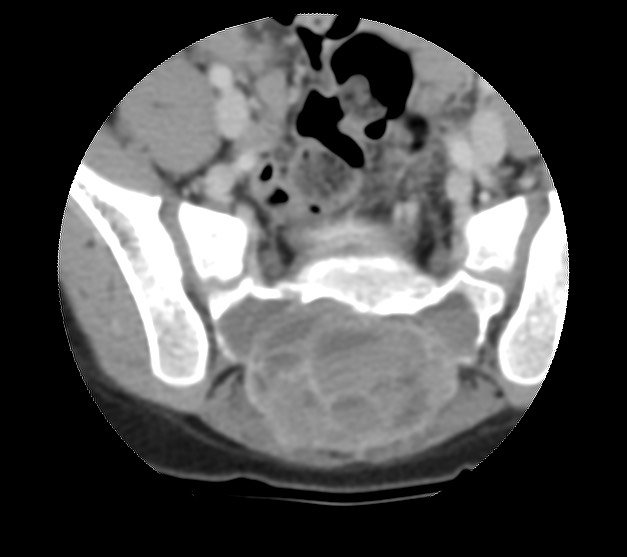 Aneurysmal bone cyst - sacrum (Radiopaedia 65190-74195 Axial non-contrast 23).jpg