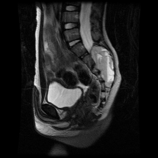 File:Aneurysmal bone cyst - sacrum (Radiopaedia 65190-74196 Sagittal T2 17).jpg