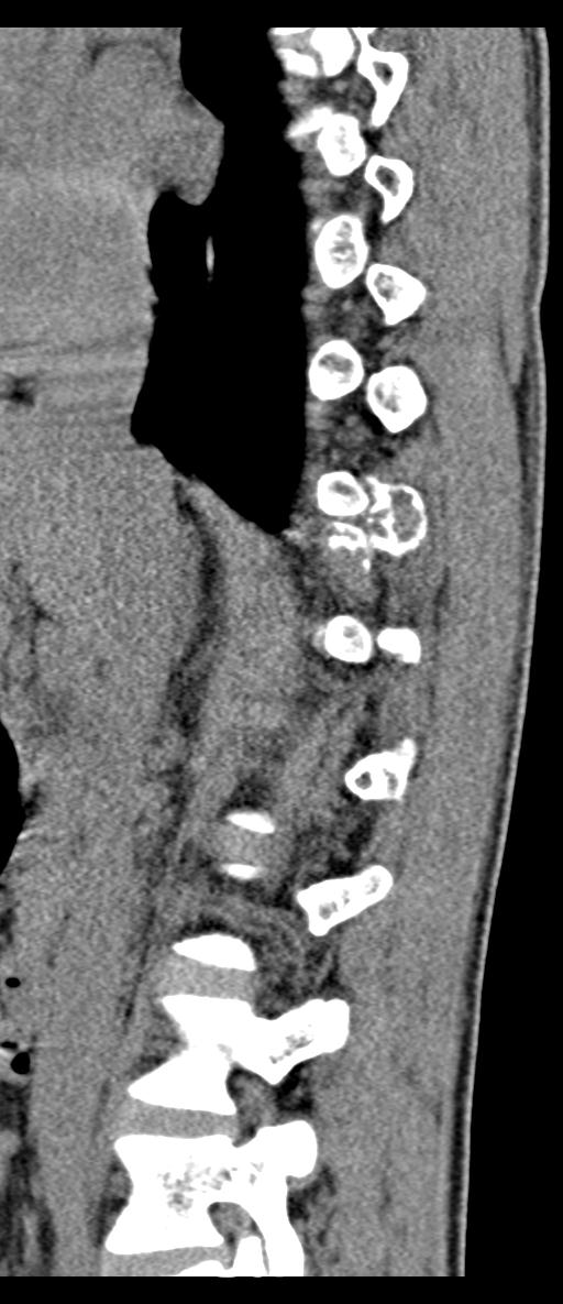 Aneurysmal bone cyst T11 (Radiopaedia 29294-29721 E 54).jpg