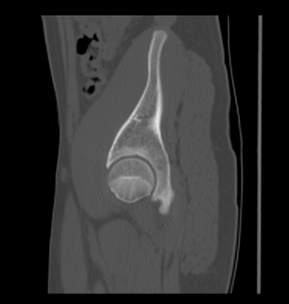 Aneurysmal bone cyst of ischium (Radiopaedia 25957-26094 Sagittal bone window 56).png