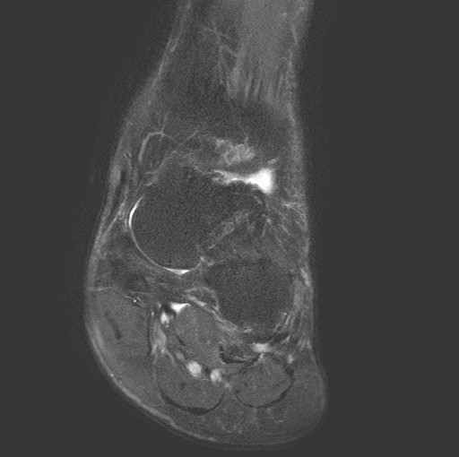 File:Aneurysmal bone cyst of the calcaneus (Radiopaedia 60669-68420 Coronal T2 fat sat 4).jpg
