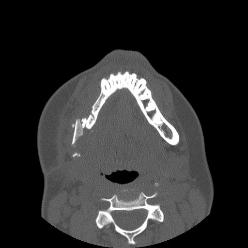 Aneurysmal bone cyst of the mandible (Radiopaedia 43280-46823 Axial bone window 43).jpg