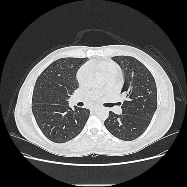Angioinvasive aspergellosis (Radiopaedia 66995-76315 Axial lung window 24).jpg