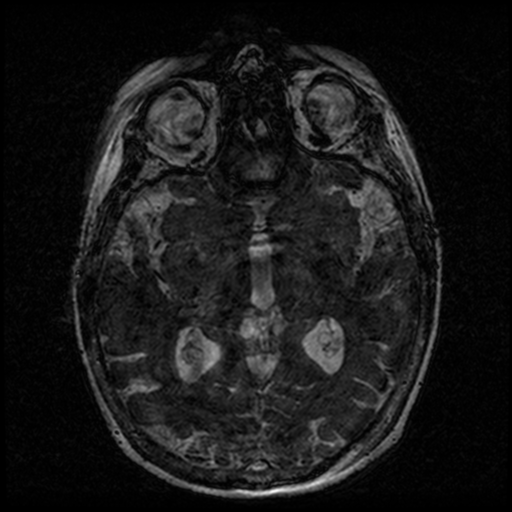 Angioinvasive aspergillosis in the pituitary fossa (Radiopaedia 39676-42010 Ax 3D FIESTA VOLUME 90).png