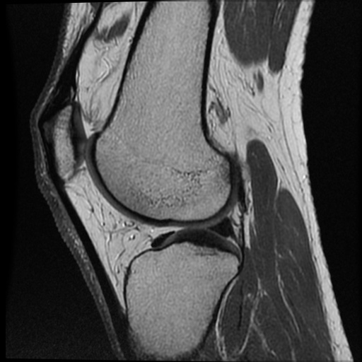 Anomalous insertion of the medial meniscus (Radiopaedia 77559-89721 Sagittal PD 21).jpg