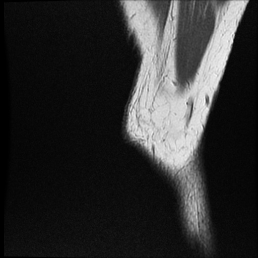 Anomalous insertion of the medial meniscus (Radiopaedia 77559-89721 Sagittal PD 53).jpg