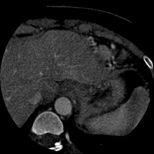 File:Anomalous left coronary artery from the pulmonary artery (ALCAPA) (Radiopaedia 40884-43586 A 86).jpg