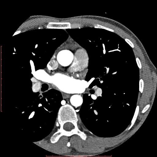 Anomalous left coronary artery from the pulmonary artery (ALCAPA) (Radiopaedia 70148-80181 A 44).jpg