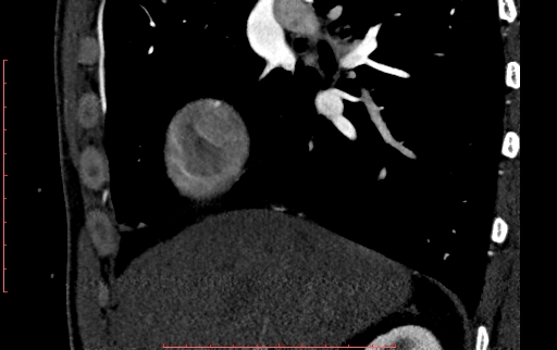 Anomalous left coronary artery from the pulmonary artery (ALCAPA) (Radiopaedia 70148-80181 C 9).jpg