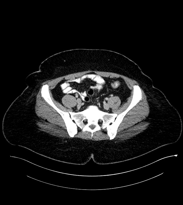 Anterior abdominal wall CSF pseudocyst (CSFoma) (Radiopaedia 79453-92571 A 69).jpg