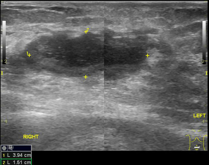 File:Anterior abdominal wall abscess - post LSCS (Radiopaedia 30343-30989 A 1).jpg