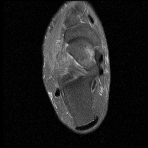 File:Anterior calcaneal process fracture (Radiopaedia 71377-81705 Axial PD fat sat 10).jpg