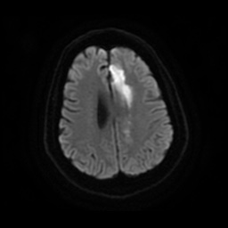 Anterior cerebral artery infarction (Radiopaedia 46794-51323 Axial DWI 20).jpg
