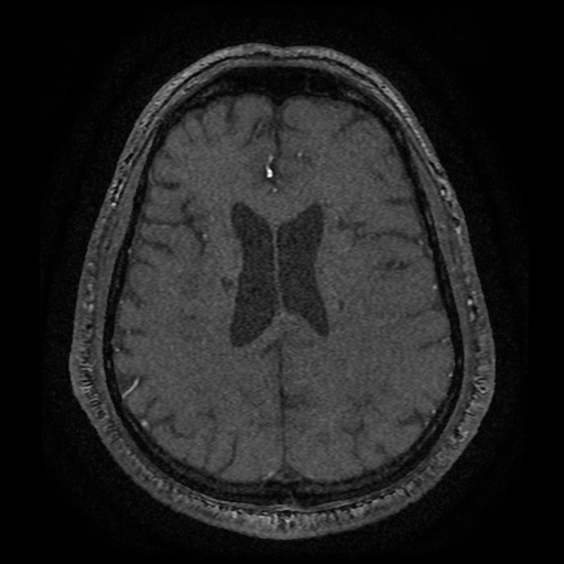 Anterior cerebral artery infarction (Radiopaedia 46794-51323 Axial MRA 149).jpg
