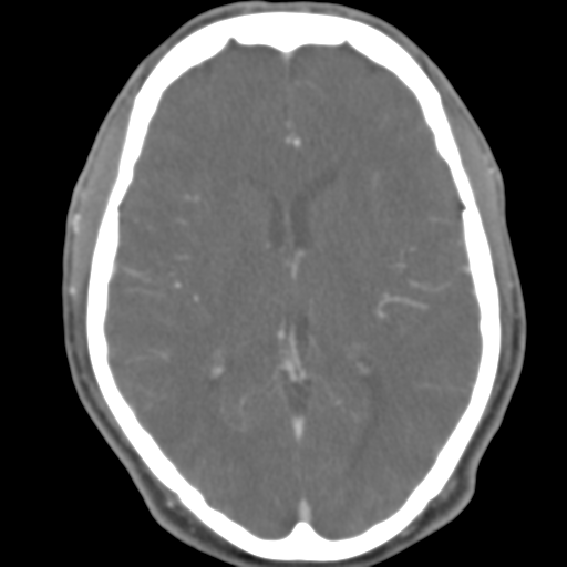 File:Anterior cerebral artery territory infarct (Radiopaedia 39327-41581 B 29).png