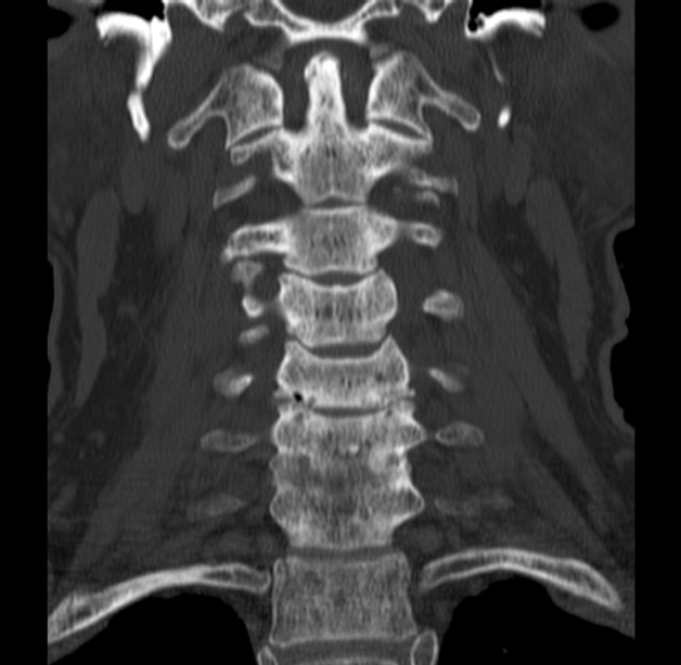 Anterior cervical postdiscectomy arthrodesis (Radiopaedia 32678-33646 Coronal bone window 26).jpg