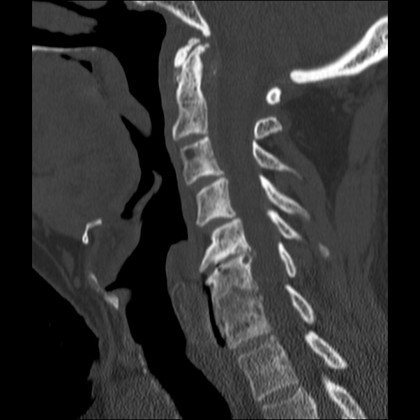 Anterior cervical postdiscectomy arthrodesis (Radiopaedia 32678-33646 Sagittal bone window 33).jpg