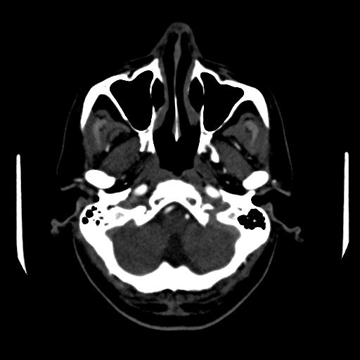 File:Anterior communicating artery aneurysm (Radiopaedia 16633-16335 A 4).jpg
