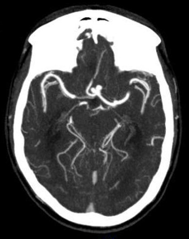 File:Anterior communicating artery aneurysm (Radiopaedia 16633-16335 B 1).jpg