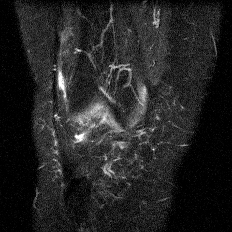 File:Anterior cruciate ligament mucoid degeneration (Radiopaedia 60853-68633 Coronal STIR 12).jpg