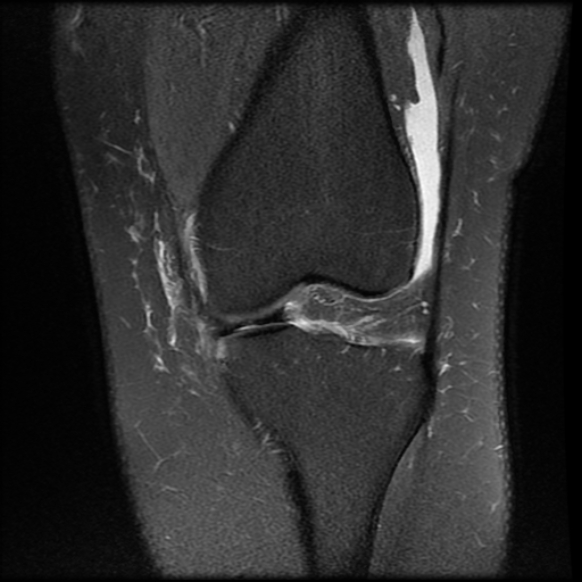 File:Anterior cruciate ligament tear, Wrisberg rip and bucket-handle tear of medial meniscus (Radiopaedia 75872-87266 Coronal PD fat sat 11).jpg