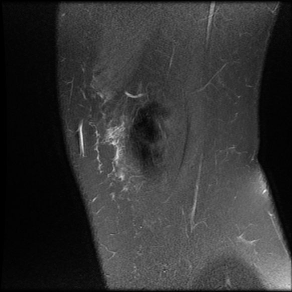 File:Anterior cruciate ligament tear, Wrisberg rip and bucket-handle tear of medial meniscus (Radiopaedia 75872-87266 Sagittal PD fat sat 25).jpg