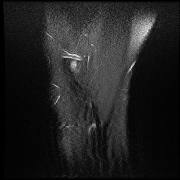 File:Anterior cruciate ligament tear with posteromedial corner injury, bucket-handle meniscal tear and chondral delamination (Radiopaedia 75501-86744 Sagittal PD fat sat 27).jpg