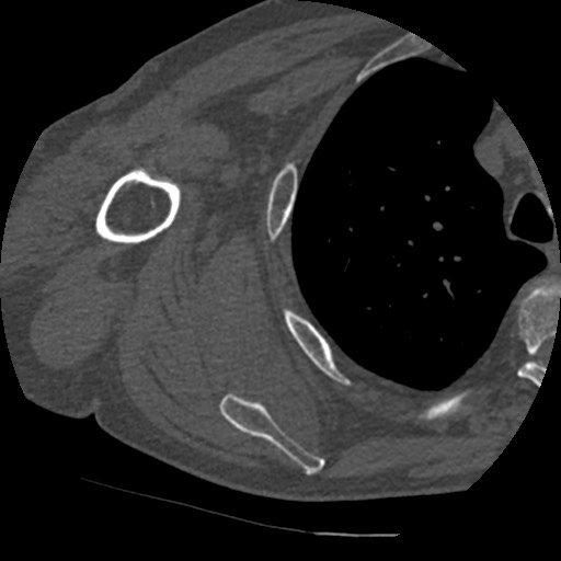 File:Anterior glenohumeral dislocation with Hill-Sachs lesion (Radiopaedia 62877-71249 Axial bone window 64).jpg