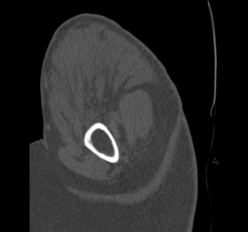 Anterior glenohumeral dislocation with Hill-Sachs lesion (Radiopaedia 62877-71249 Sagittal bone window 16).jpg