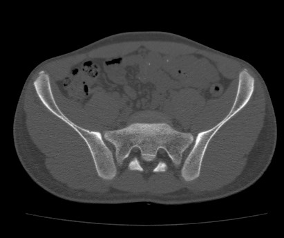 Anterior inferior iliac spine avulsion fracture (Radiopaedia 81312-94999 Axial bone window 27).jpg